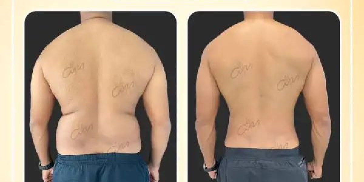 Achieve Your Dream Body with Liposuction in Dubai by Dr. Hans