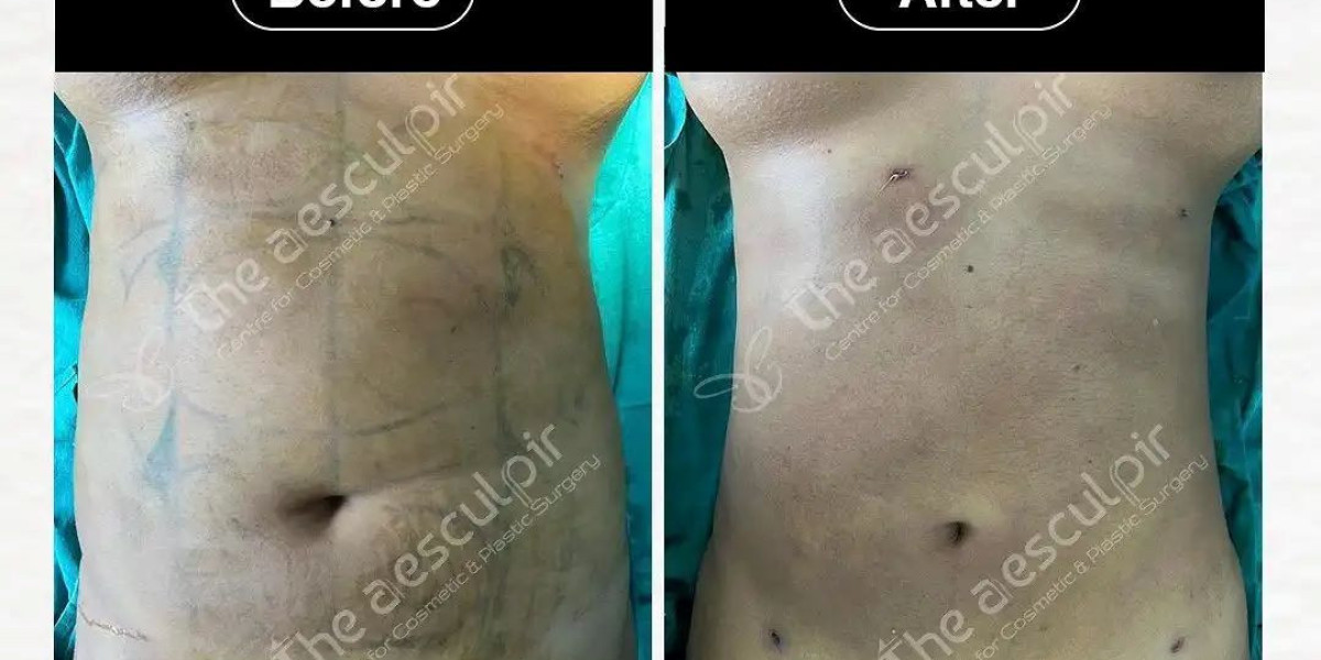 Achieve a Sculpted Look with Liposuction Surgery in India at Theaesculpir