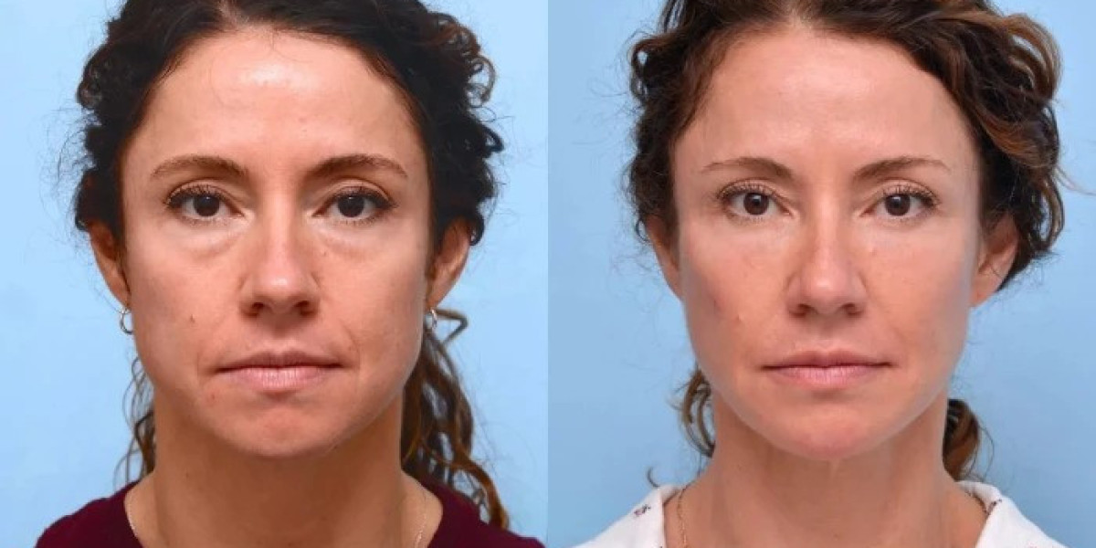 Thread Lift Treatment in Dubai: Minimal Downtime, Maximum Impact