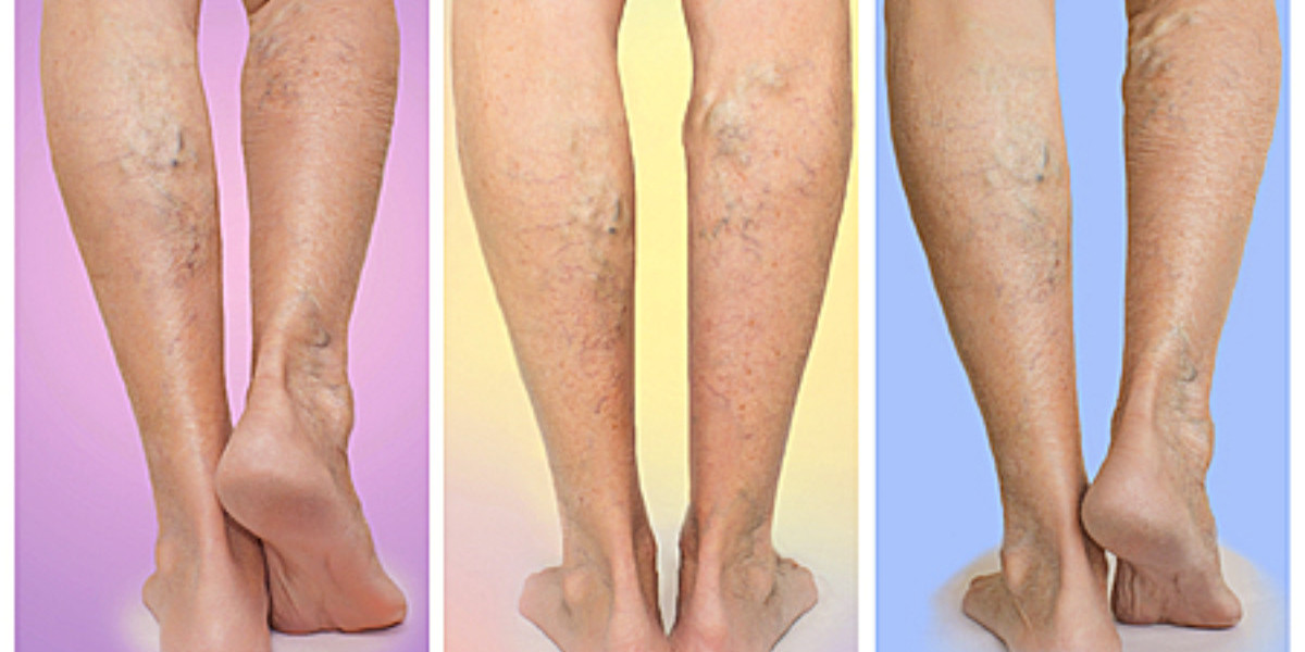 Peripheral Artery Disease (PAD): Early Warning Signs You Shouldn't Ignore