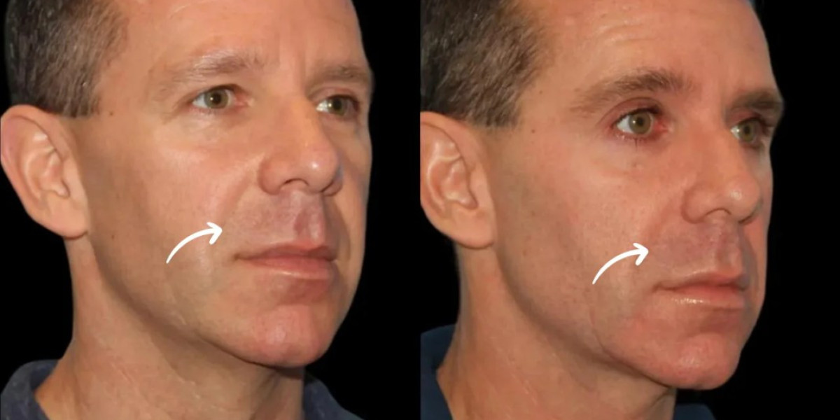 Hygiene and aseptic protocols in Sculptra Fillers by Dubais Best Doctors