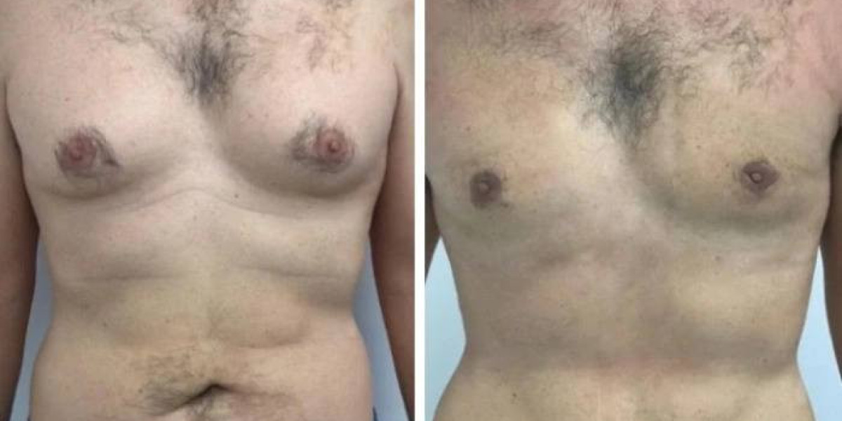 Cost Expectations from the Best Gynecomastia Surgeons in Dubai