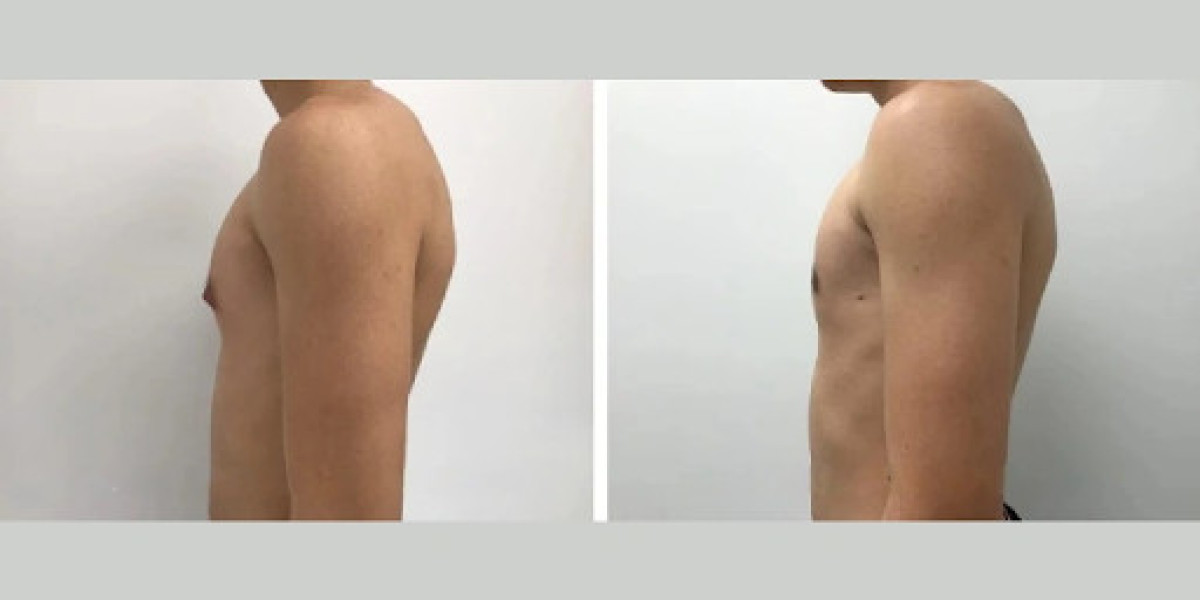 What Are the Common Techniques Used by the Best Gynecomastia Surgeons in Dubai?