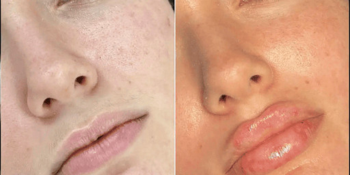 Fillers Treatment in Dubai: What You Should Know Before Booking