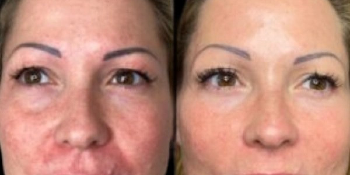 Embrace Ageless Radiance with Profhilo by the Best Doctors in dubai