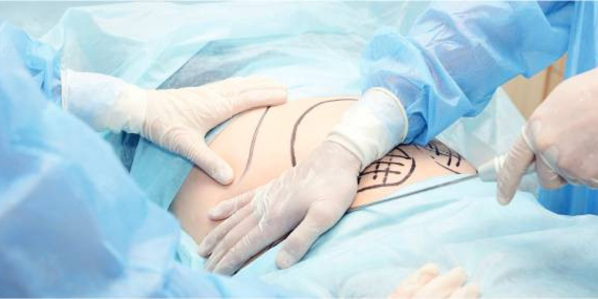 Tummy Tuck in Dubai: Tighten and Tone Your Abdominal Contour