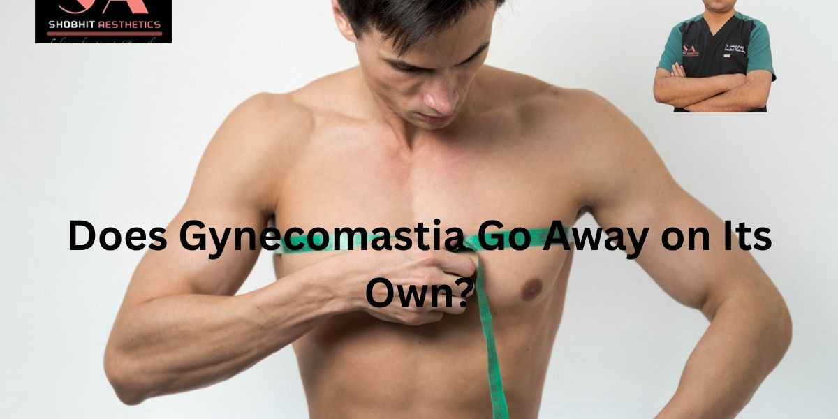Does Gynecomastia Go Away on Its Own?