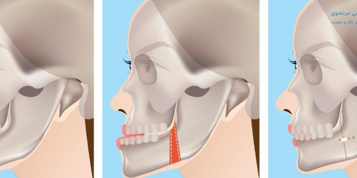 Price of Jaw Surgery Explained: How Location and Procedure Type Affect Expenses