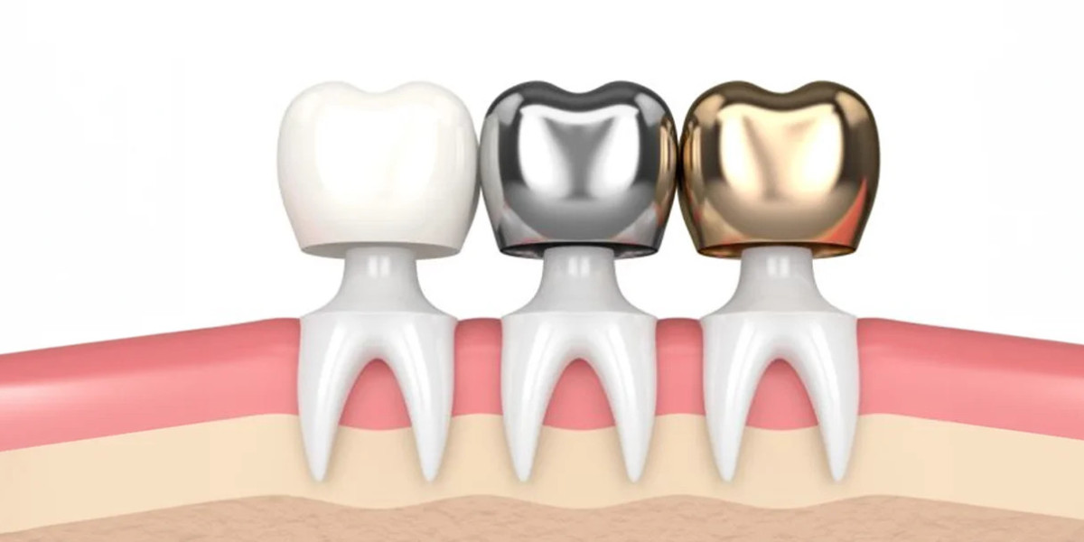 Types of Dental Crowns and Cost: A Complete Guide for Patients