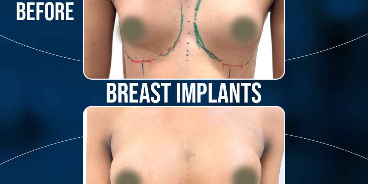 Top-Rated Breast Implants in Hyderabad – Affordable, Safe & Expert Care at Personiks (2025 Guide)