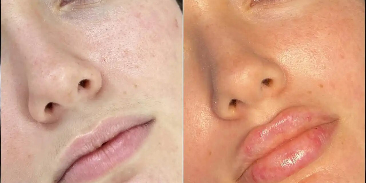 How to Choose the Best Clinic Fillers in Dubai