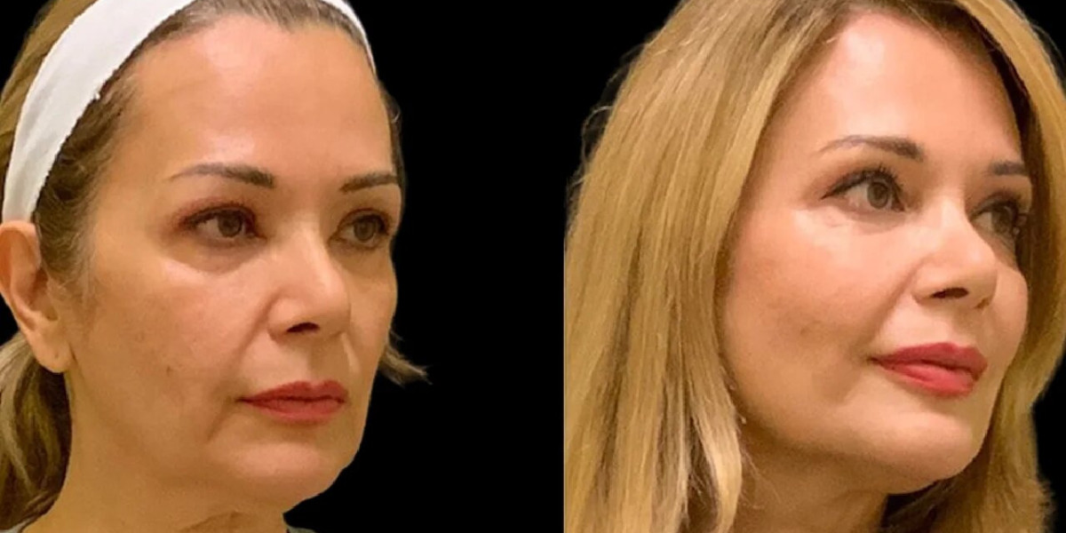 Cheek Fillers in Dubai Can They Be Combined with Other Treatments
